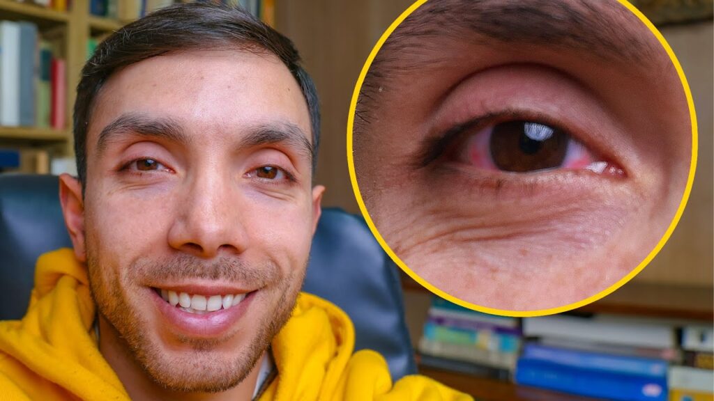 ¿Por qué se ponen los ojos rojos al Consumir cannabis?